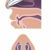 Splint Nasal - Image 3